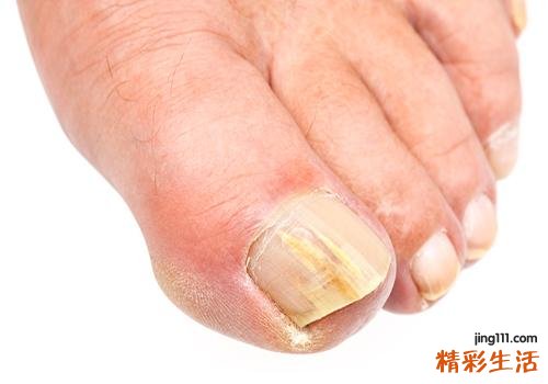 怎么确定是不是灰指甲 这几个方面教你怎么判断是不是灰指甲