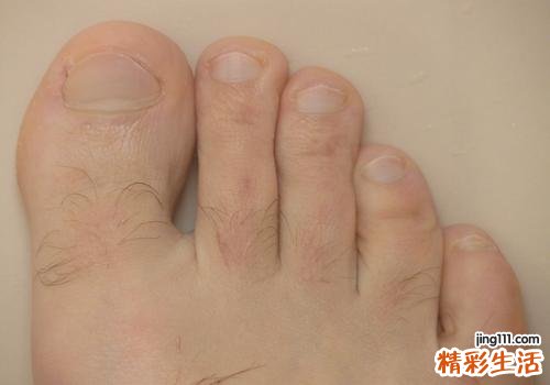 脚趾甲里有白色的东西是什么 脚趾甲和肉中间有白色怎么回事