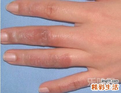 手烫伤了怎么办