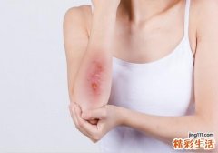 烫伤怎么做才不会留疤 烫伤疤痕怎么去除