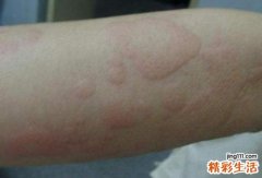 荨麻疹拔罐可以治愈嘛 荨麻疹拔罐拔哪里图片