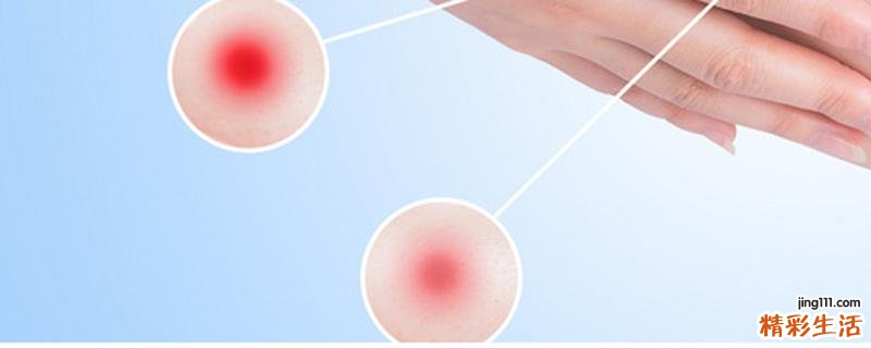 荨麻疹用艾叶禁忌 荨麻疹最快治疗方法