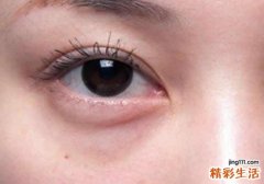 下眼袋浮肿怎么办 去除下眼袋浮肿，其实很简单！