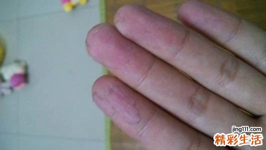 手心脚心发热是怎么回事