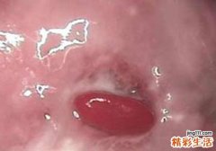 白带多而且稠是怎么回事