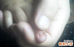 小孩指甲脱落还能长吗