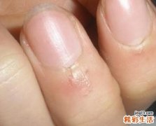 指甲周围长倒刺是缺维生素吗