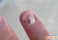 指甲脱落是什么原因