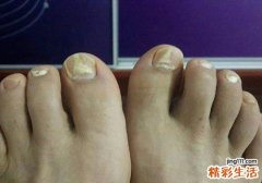 灰指甲里面有黑色的线 指甲里面有黑色线还有什么原因