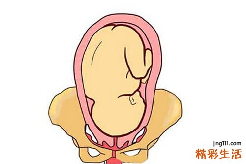胎位有哪几种