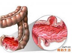 右下腹部疼痛的可能病因