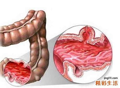 右下腹部疼痛的可能病因