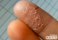 手指脱皮缺什么维生素