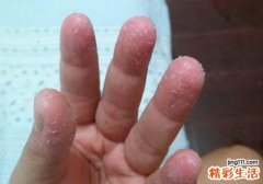 手指脱皮疼痛怎么回事