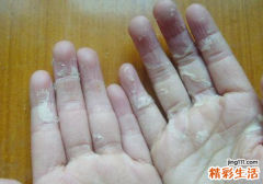 手指脱皮痒是怎么回事