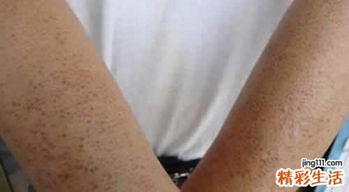 磨砂膏能去鸡皮肤吗