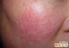 脸颊有红血丝怎么回事