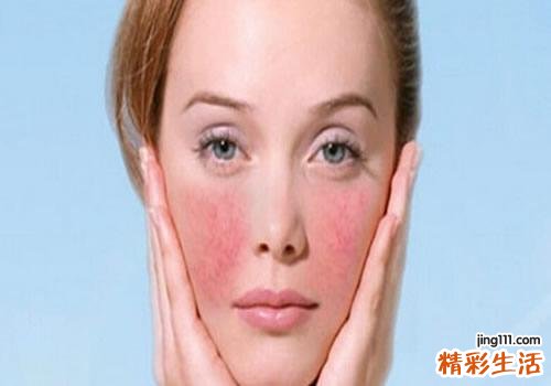 脸上有红血丝是敏感肌肤吗 红血丝敏感肌肤的保养方法