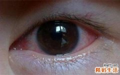 眼睛有红血丝是怎么回事 眼睛有红血丝有什么对策