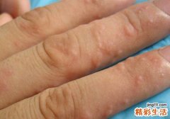 夏天手上起小水泡怎么回事
