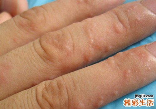 夏天手上起小水泡怎么回事