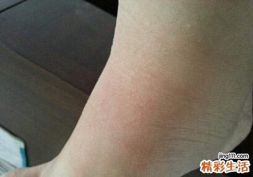 脚上起了好多小疙瘩特别痒