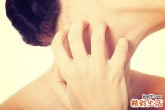 三伏贴起水泡怎么办