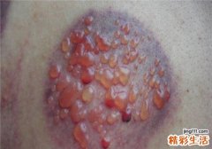 拔火罐起水泡是什么原因
