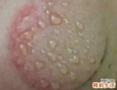 拔罐水泡是什么原因