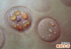 拔罐起水泡怎么处理