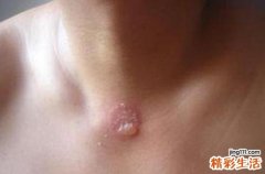 艾灸出水泡是怎么回事 艾灸出水泡是否继续灸