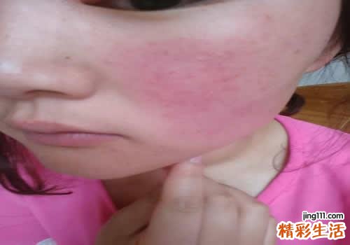 西瓜皮敷脸去红血丝吗 红血丝要谨慎使用西瓜皮敷脸