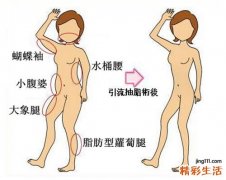 抽脂后多久可以瘦