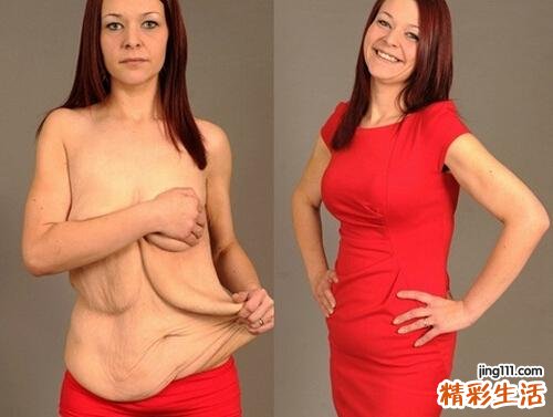 吸脂会导致皮肤松弛吗 吸脂后皮肤会不会松弛