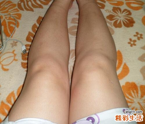大腿溶脂针能保持多久 溶脂针瘦腿维持多久