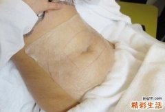 冷冻溶脂注意事项