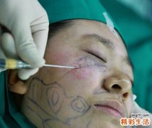 面部吸脂皮肤会松弛吗