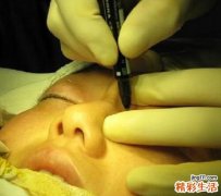 面部吸脂多久恢复 面部吸脂恢复多久