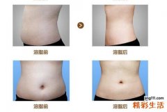 溶脂后留下硬块如何处理 溶脂后留下硬块怎么办