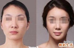 瘦脸针多少钱一次