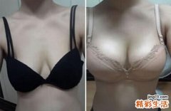 自体脂肪丰胸的价格