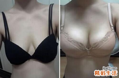 自体脂肪丰胸的价格