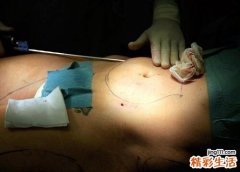 抽脂减肥价格一览表