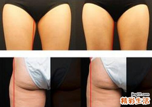 冷冻溶脂价格