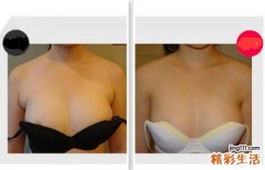 副乳切除手术费用