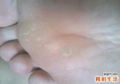 鸡眼与跖疣的鉴别
