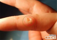 鱼痣怎么得的