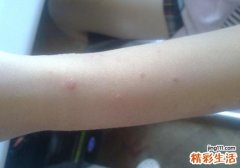 脚上起水泡是什么原因