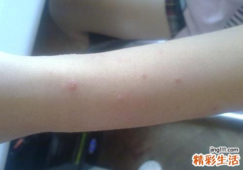 脚上起水泡是什么原因