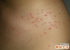 皮疹的症状